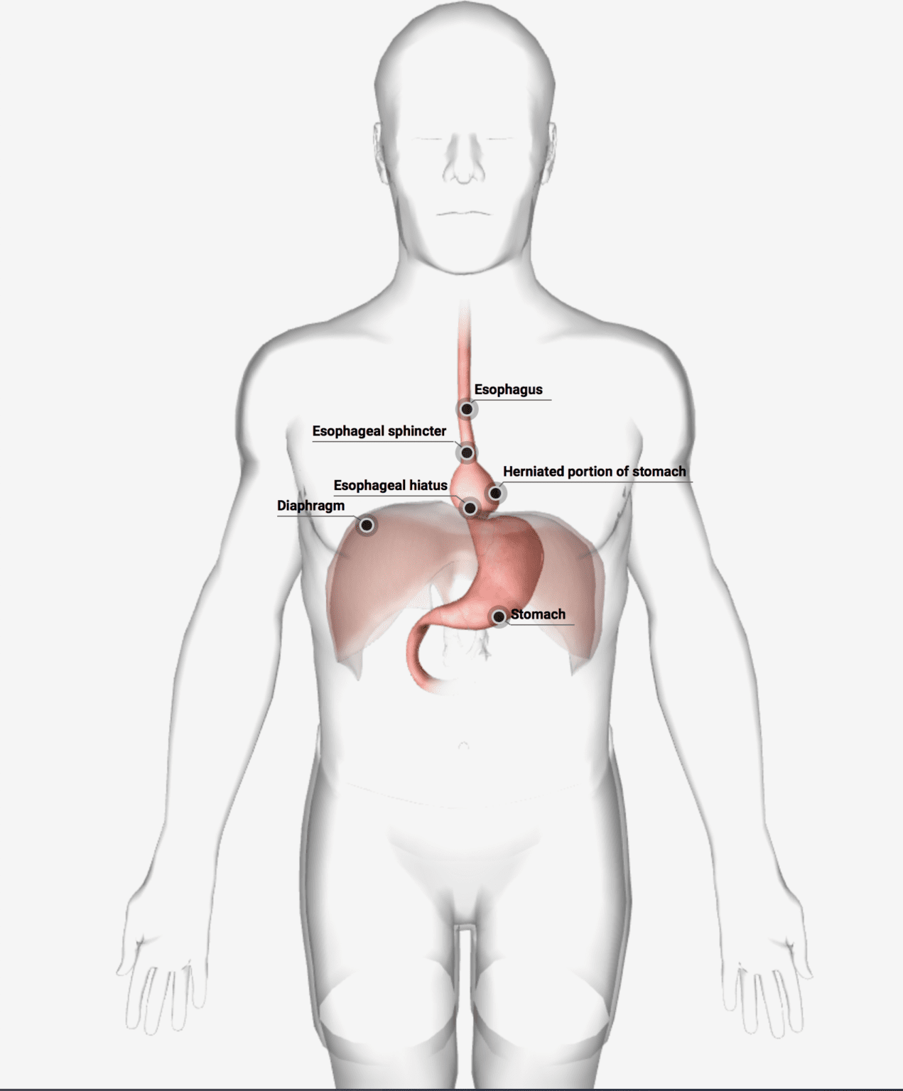 CIRUGÍA DE HERNIA HIATAL Cirugía Sin Fronteras CSF