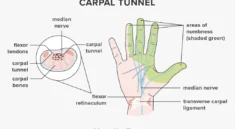 CARPAL TUNNEL SYNDROME