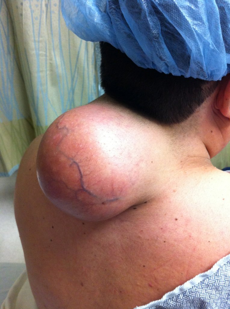 Lipoma en la espalda: ¿es realmente inofensivo?